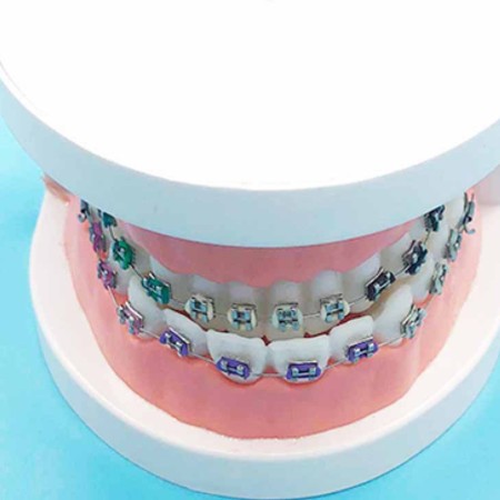 正畸模型 牙科材料 正畸矫正模型 大金属托槽模型 口腔齿科器材