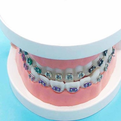 正畸模型 牙科材料 正畸矫正模型 大金属托槽模型 口腔齿科器材